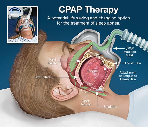 CPAP Masks